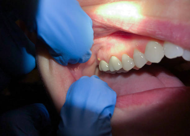 Best Broken or Cracked Tooth Emergency Dentist in Francis, UT
