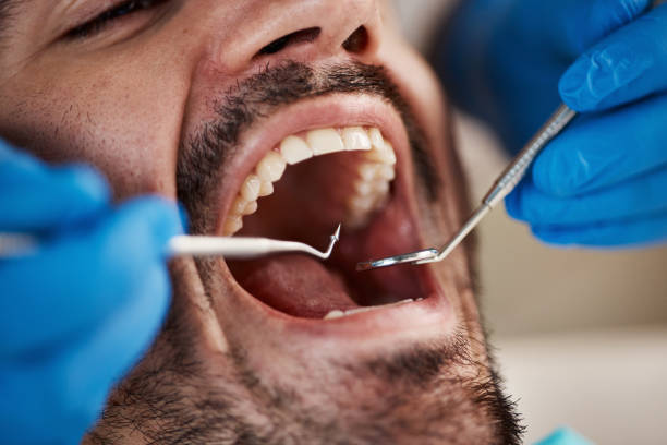 Best Emergency Dental Extractions in Francis, UT